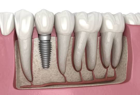 Close-up model of a dental implant with titanium post, abutment and crown