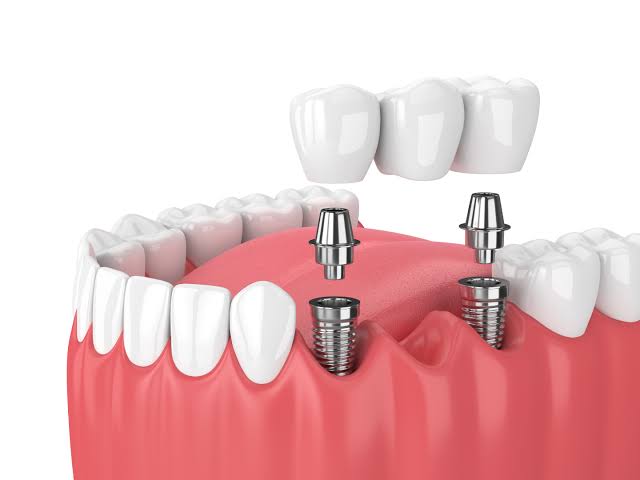 Cross-section diagram of a dental implant in the jawbone with abutment and crown