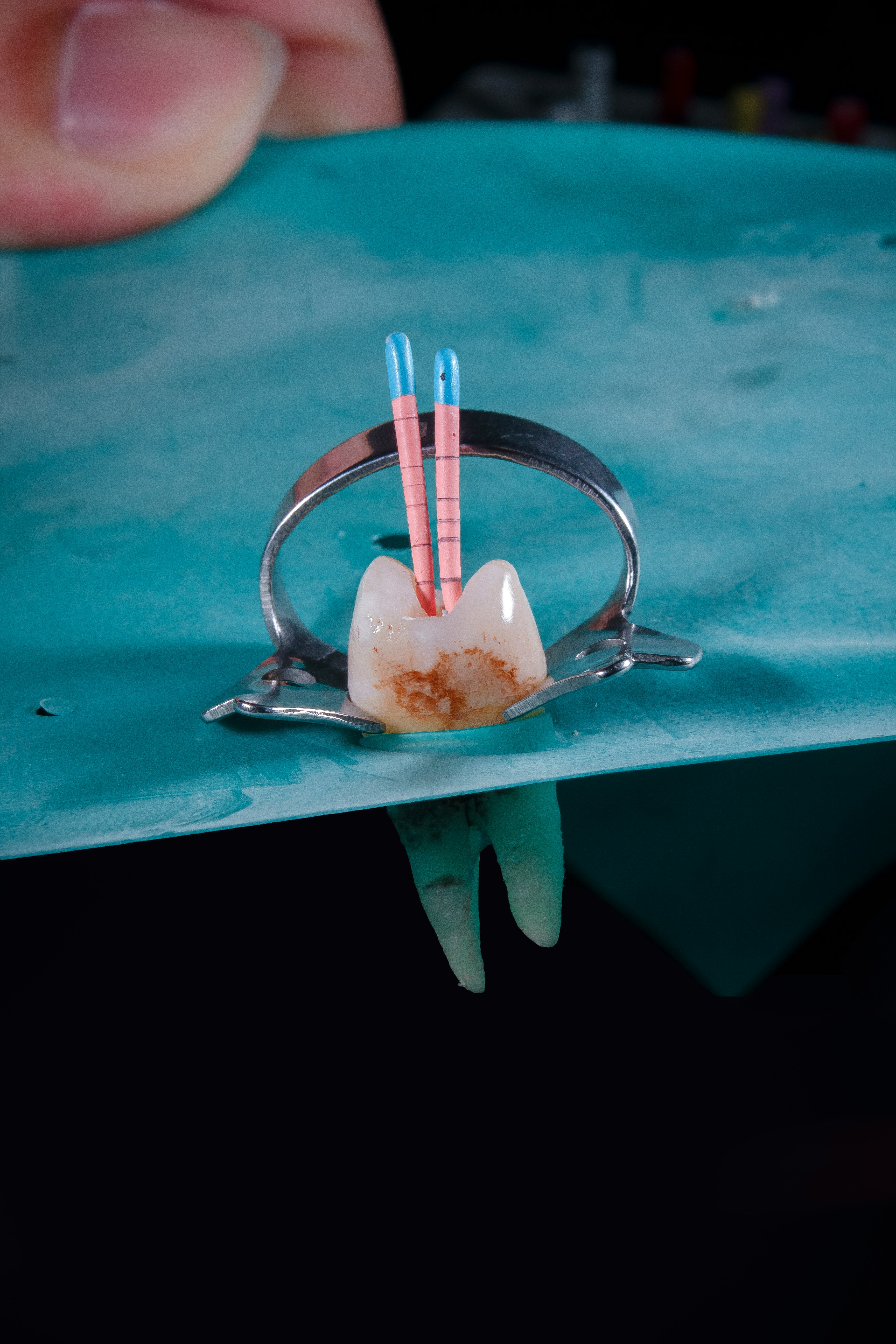 Illustration of a root canal treatment on an infected tooth