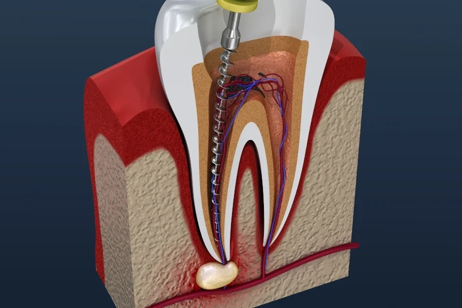Cross-section diagram of a tooth showing the pulp and root canals