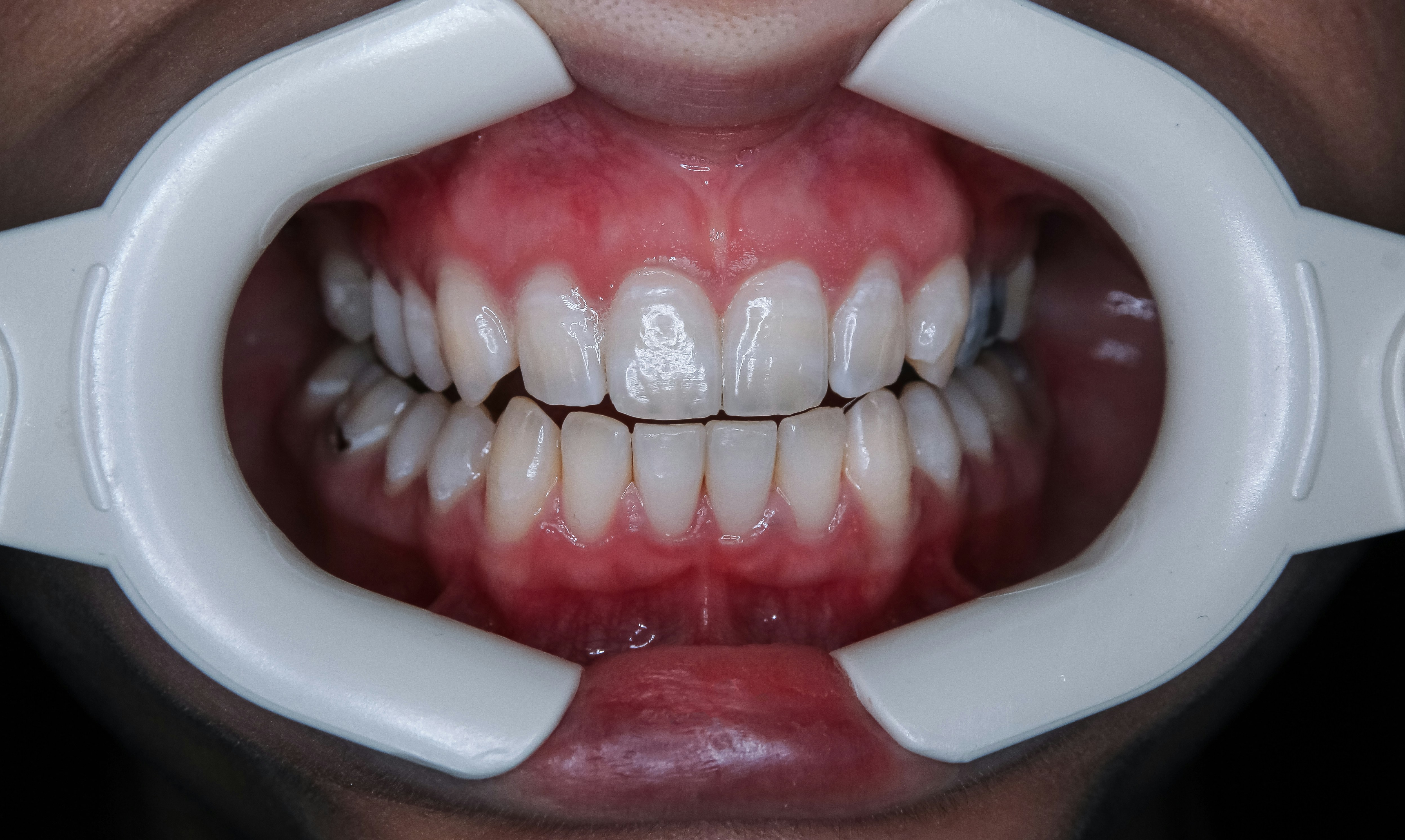 Before and after comparison of teeth whitening