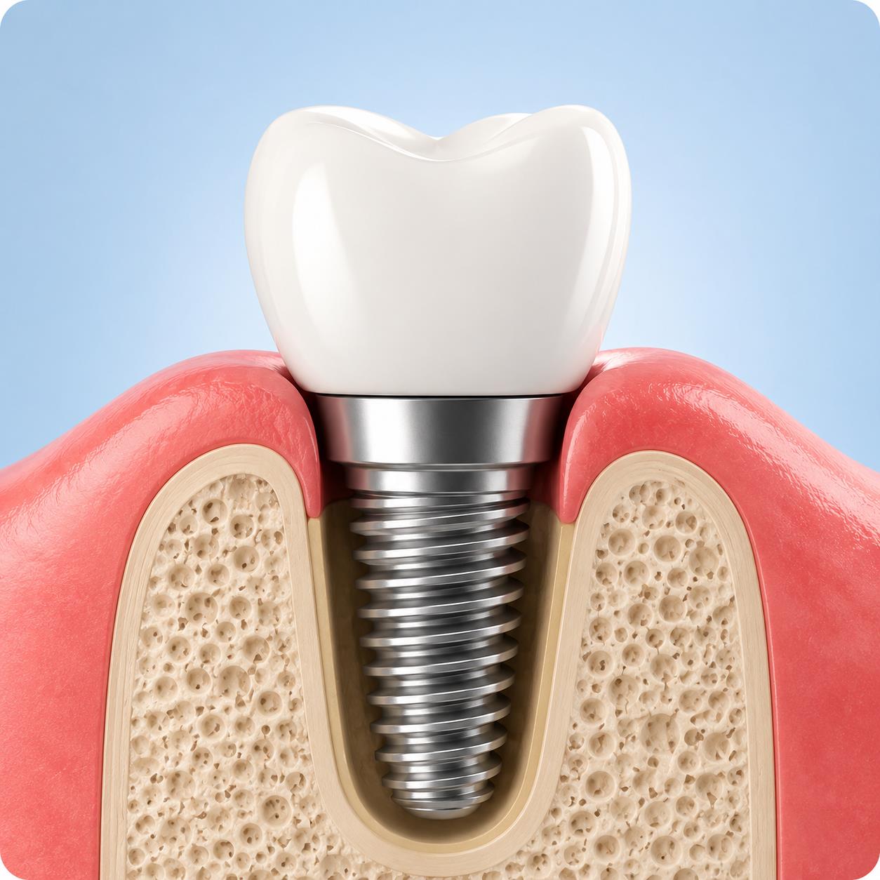 Dental implant illustration